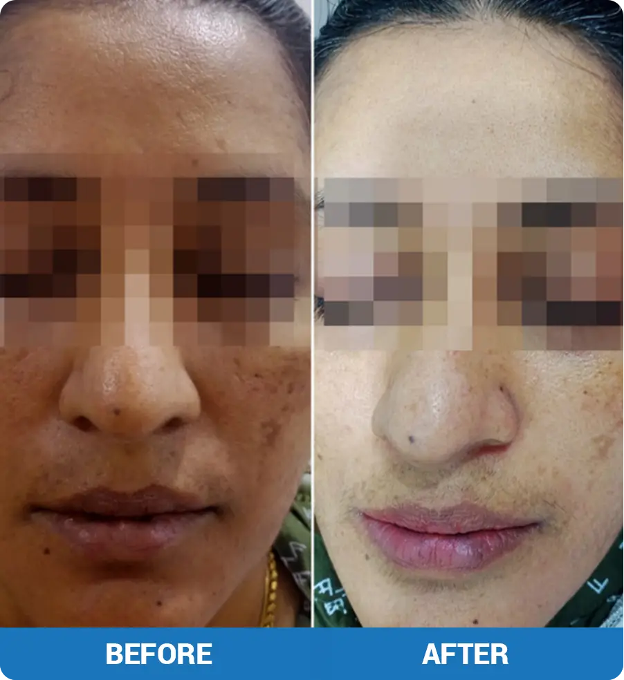 pigmentation and acne removal treatment