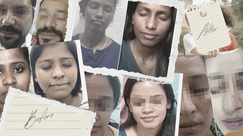 Before and After images of chemical peels