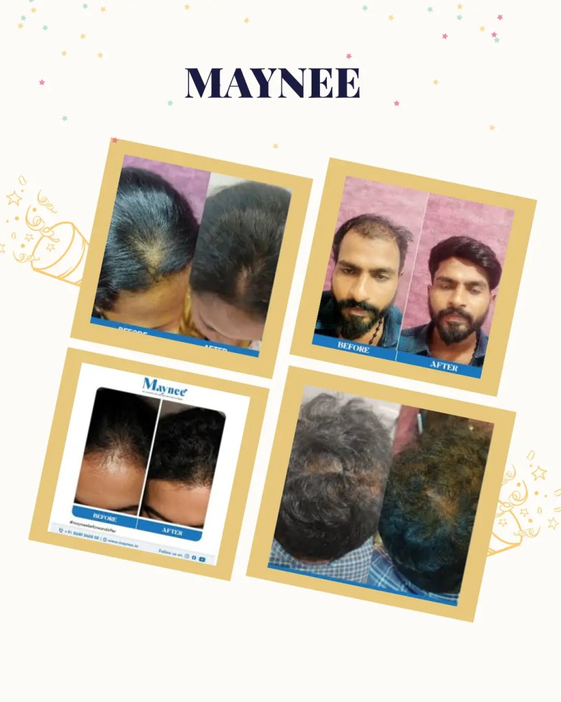 Success story of hair transplant