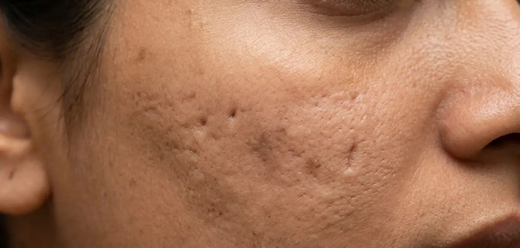 A macro skin comparison showing four types of acne scars on Indian skin: deep ice pick, wide boxcar, sloping rolling scars, and pigmentation marks