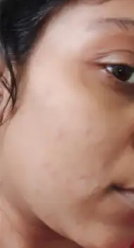After acne peel — improved skin texture and reduced scarring