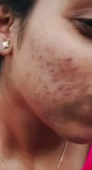 Before acne peel — acne scars and uneven skin texture