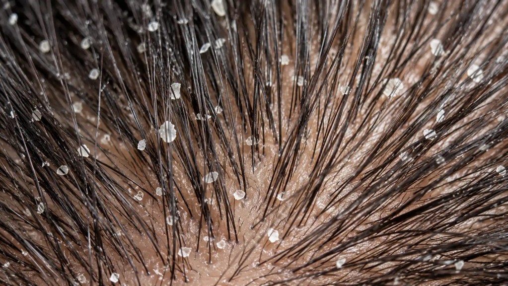 Extreme macro shot of fine, dry, white powdery dandruff flakes clinging to dark hair roots on a human scalp.
