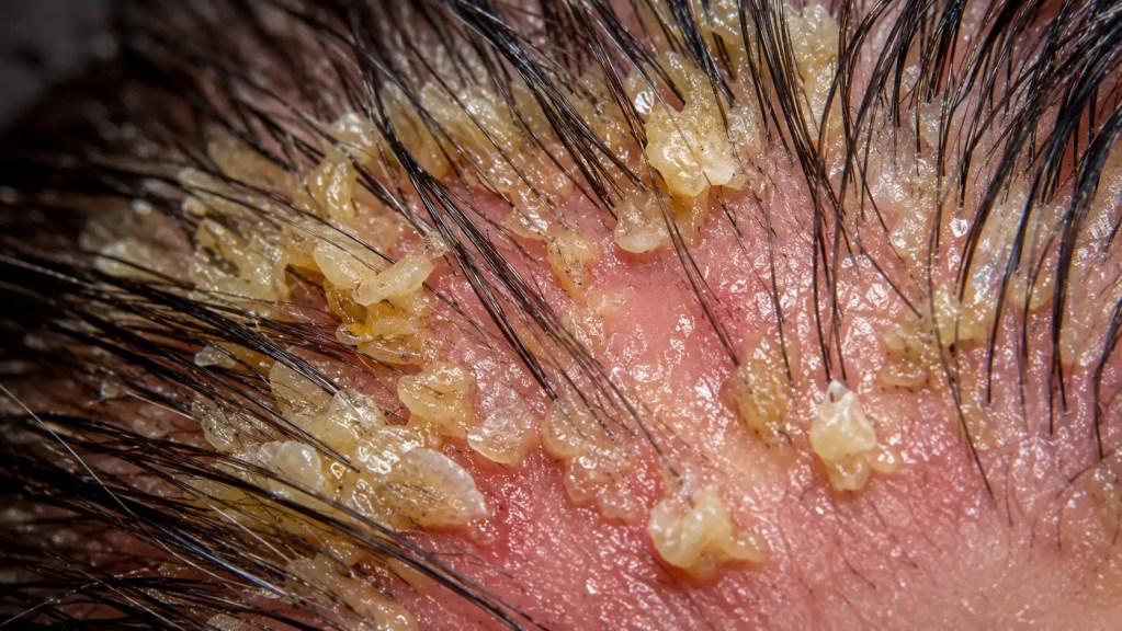 Close-up photo showing greasy, yellowish, and waxy skin scales typical of seborrheic dermatitis affecting the hairline.