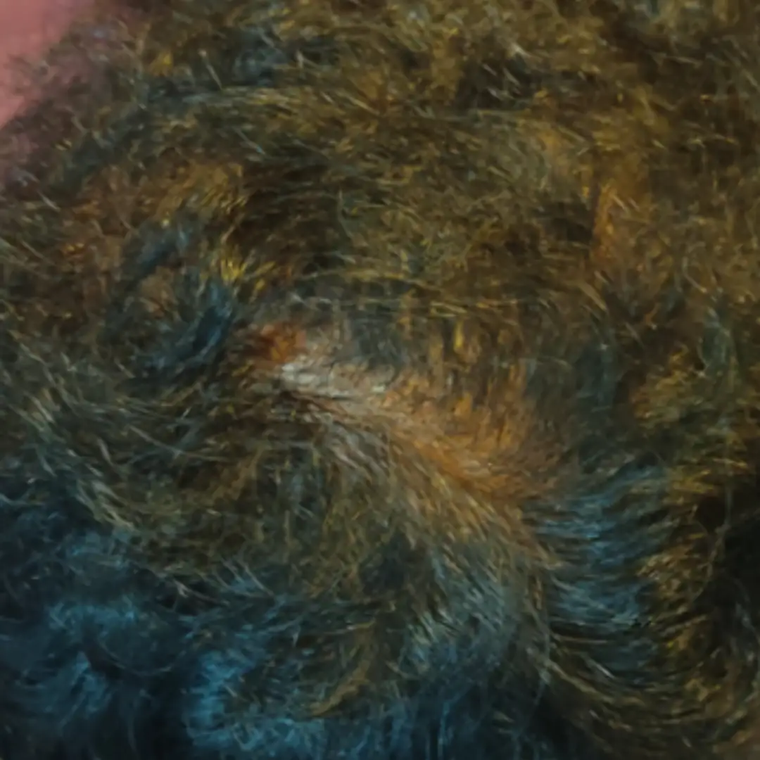 After PRP hair treatment — Baldness recovery Chennai