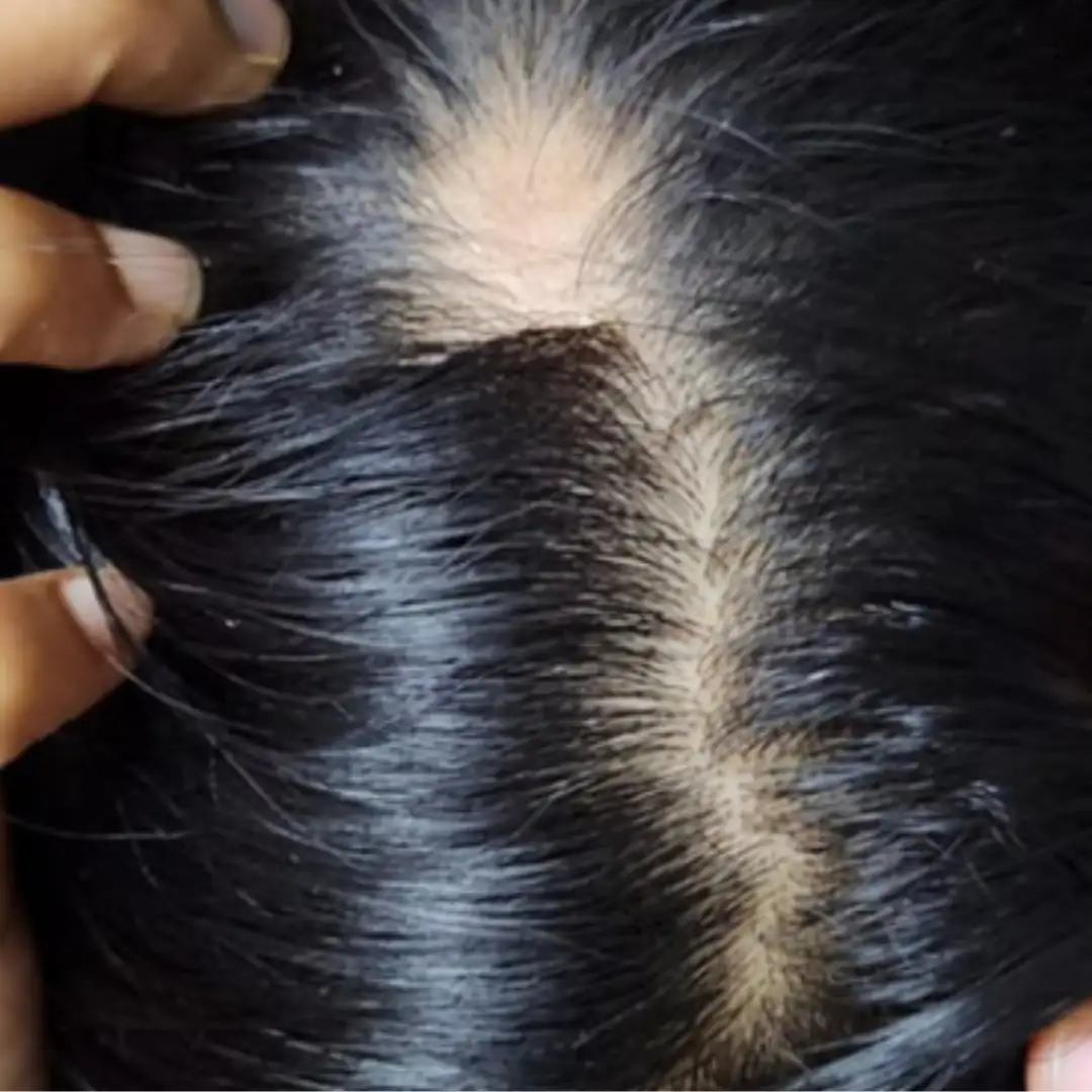 Before PRP hair treatment — male hairline recession Chennai