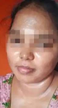 After periocular peel — reduced puffiness and dark circles