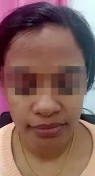 Before periocular peel — dark circles under eyes