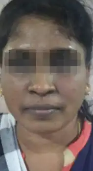 Before periocular peel — crow's feet and fine lines
