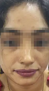 After perioral peel — even skin tone around lips