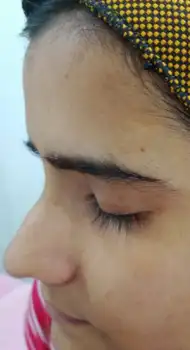 After Glycolic Peel — even skin tone and faded melasma, Maynee Chennai