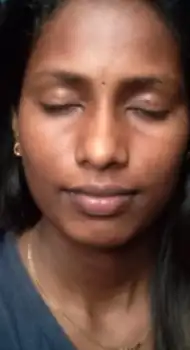 After Salicylic Peel — clear skin and reduced acne marks, Maynee Chennai