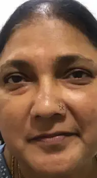 After HydraFacial — clear, glowing skin