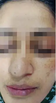 After HydraFacial — bright, even skin tone