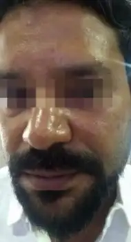 Before carbon laser facial — pigmentation and uneven skin tone