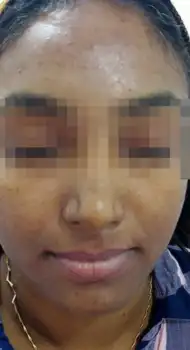 Before perioral peel — dark upper lip shadow