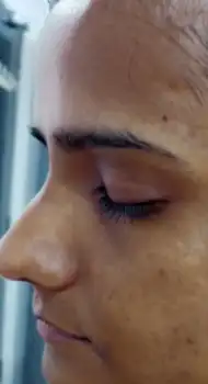 Before Glycolic Peel — melasma and hormonal pigmentation treatment Chennai