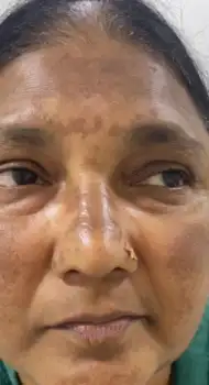 Before HydraFacial — congested skin with blackheads