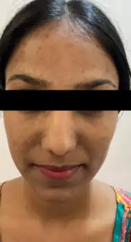 Before carbon laser facial — acne and oily skin