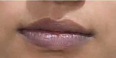 After facial laser hair removal — smooth upper lip