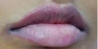 Before SPMU — dark hyperpigmented lips