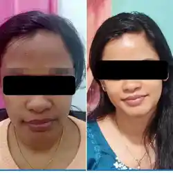Before and after skin whitening treatment at Maynee