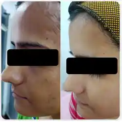 Before and after skin whitening treatment at Maynee